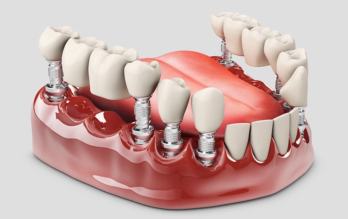 Fixed Partial Denture — before treatment