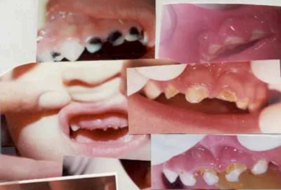 Child With Swollen Gums-1