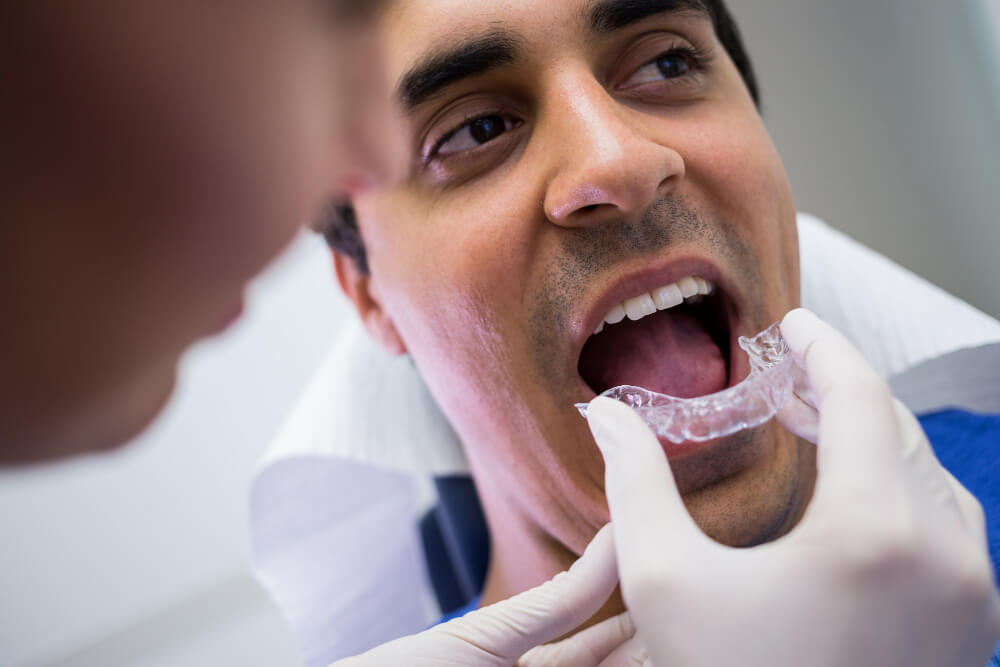 Clear-Aligners