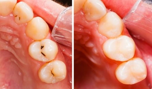Multiple Tooth Filling