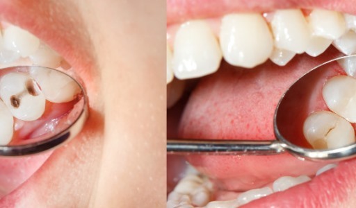 Root Canal Treatment