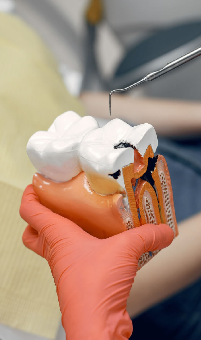 Root Canal image-01 Root Canal image-01