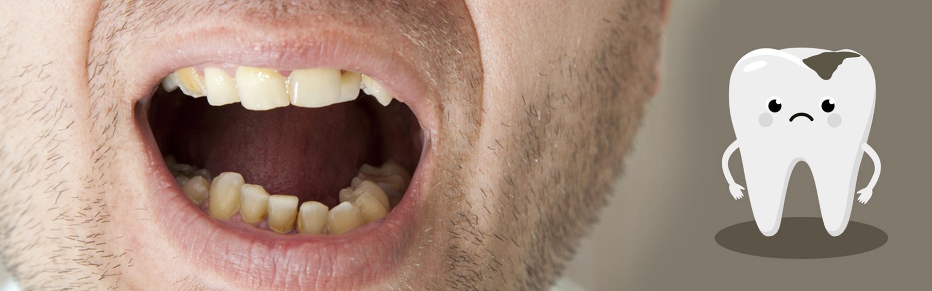 The-problem-which-Venkatesh-was-facing-–-Tooth-Decay-1 The-problem-which-Venkatesh-was-facing-–-Tooth-Decay-1