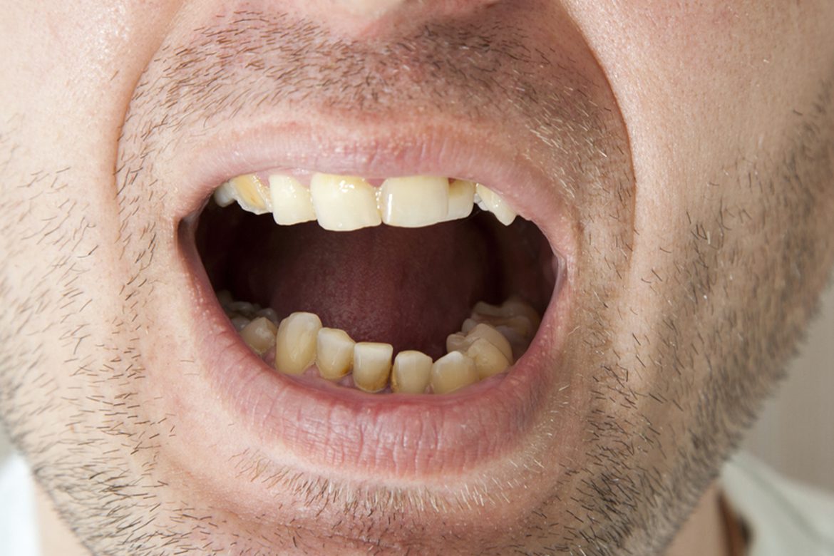 The-problem-which-Venkatesh-was-facing-–-Tooth-Decay-Thumbnail-1