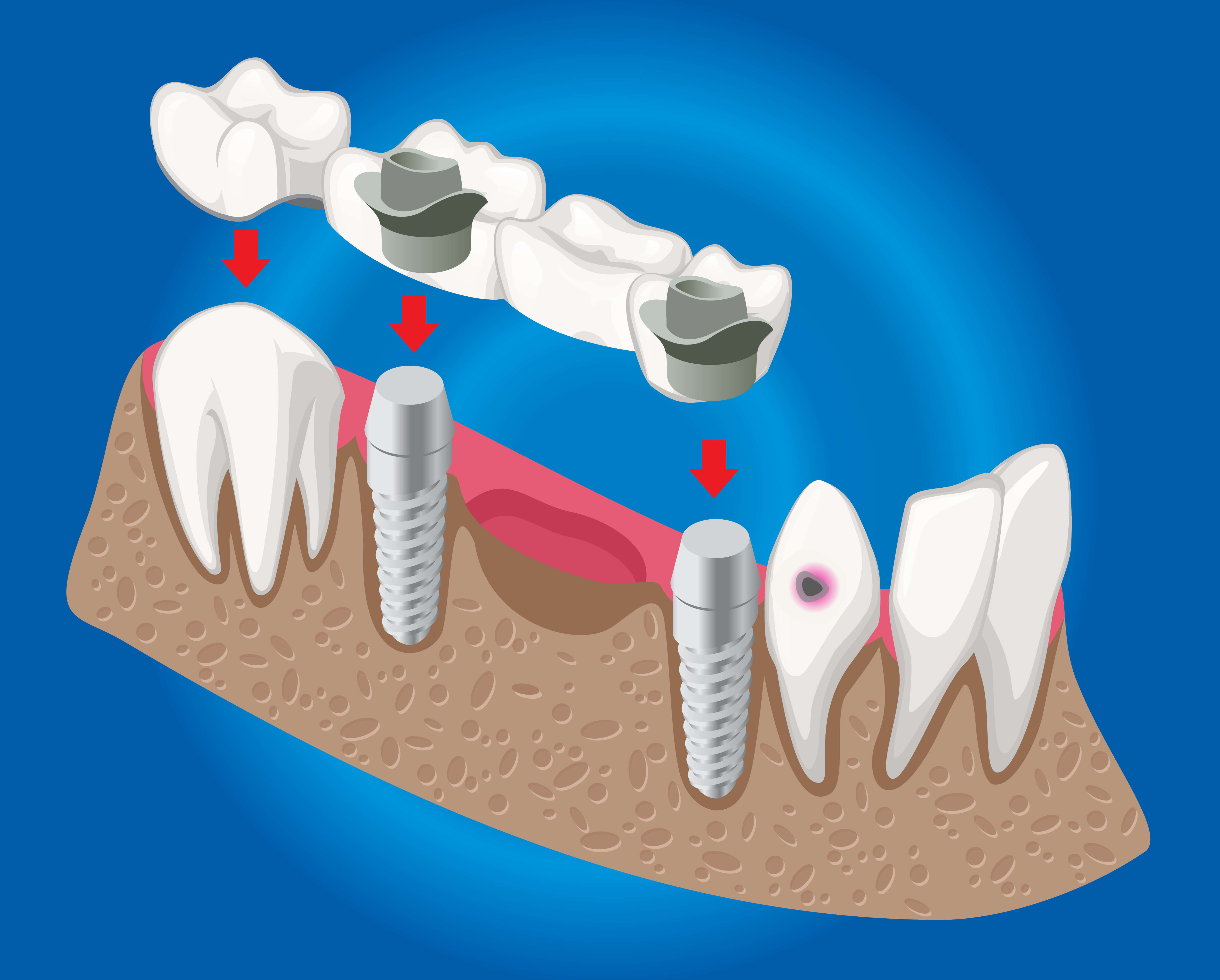 What-Are-Dental-Implants