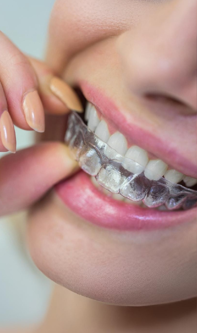 aligners image aligners image